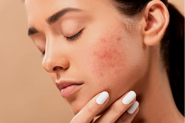 Unlocking Radiant Skin: The Ultimate Guide to Banishing Acne Scars