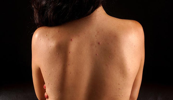 What’s Causing Your Bacne?