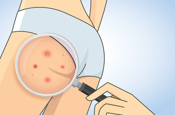 PIMPLES,WOMEN,PIMPLES ON BUM, PIMPLES ON BUTT, BUTT ACNE, ACNNE, ACNE MARKS, PIMPLES TREATMENT, PIMPLES CAUSE, BUM ACNE