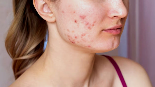 Unmasking the Culprit: Demystifying Hormonal Acne