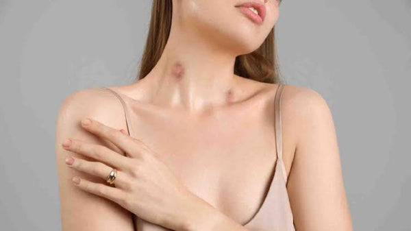 8 Effective Tips to Get Rid of Hickeys Fast