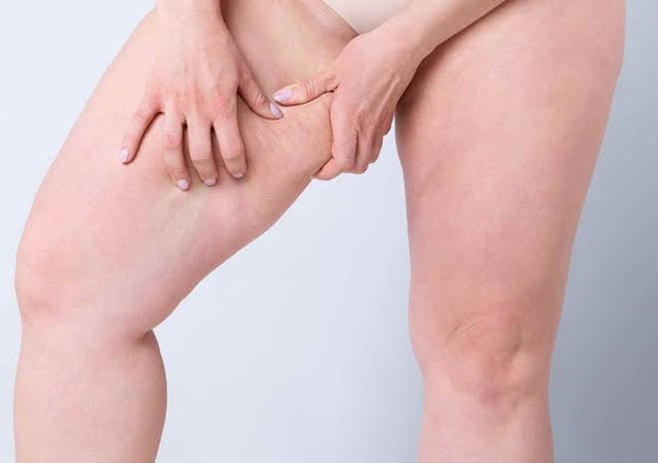 Say Goodbye to Thigh Chafing: A Guide to Preventing and Treating the Irritating Summer Woe