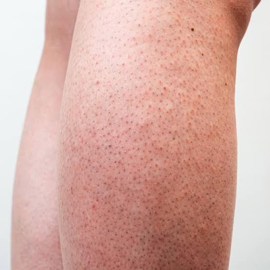 Strawberry Legs: Causes, Prevention, and Treatment Tips