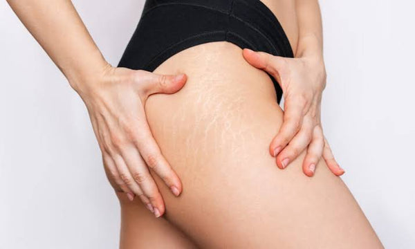 Embracing Your Journey: Understanding and Dealing with Stretch Marks