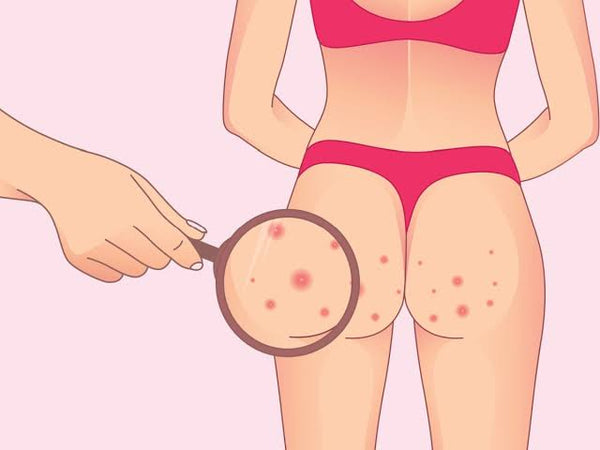 Butt Acne: Causes, Treatments, and Prevention