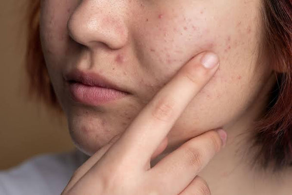 Understanding and Managing Fungal Acne: A Comprehensive Guide