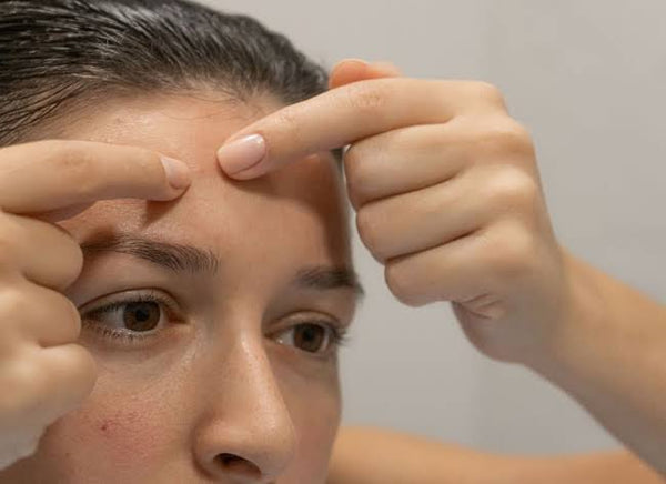 Demystifying Forehead Pimples: Causes, Prevention, and Treatment